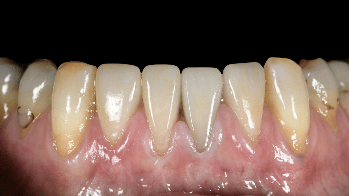 Anterior Crowns and Provisionals 1 After 916