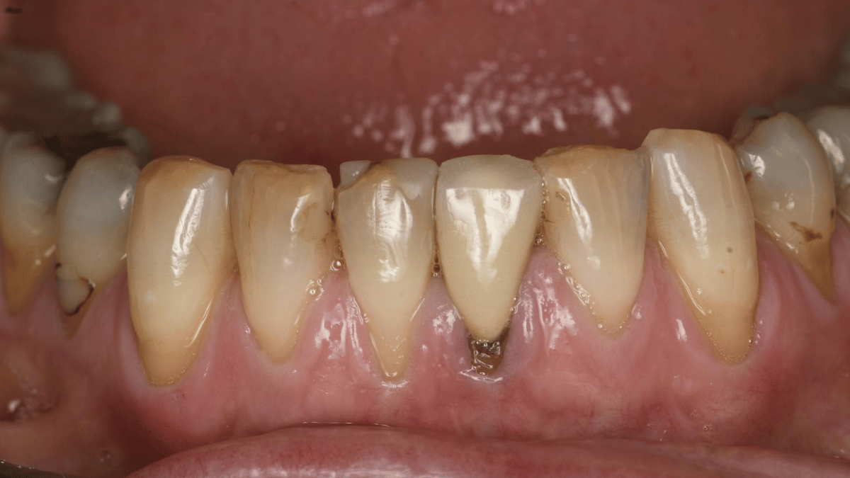 Anterior Crowns and Provisionals 1 After 9_16