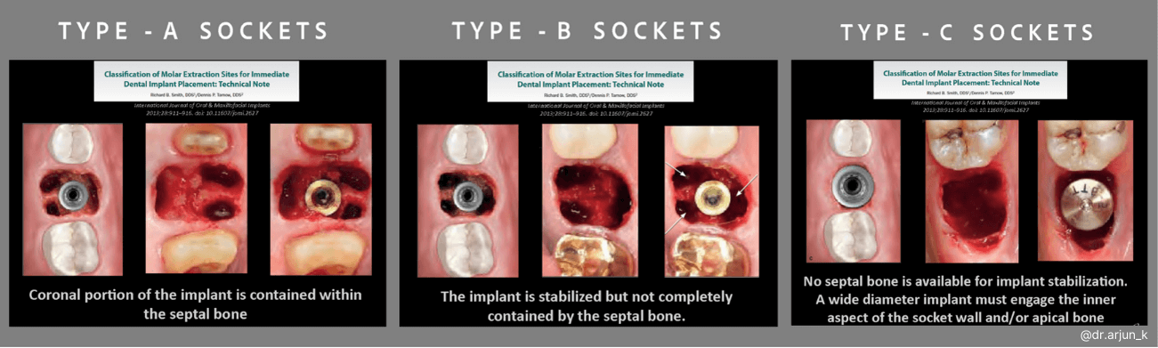 Blog  image on types of extraction sockets