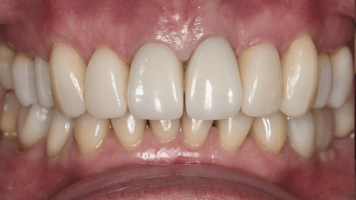 Full mouth rehab 1 after 9_16