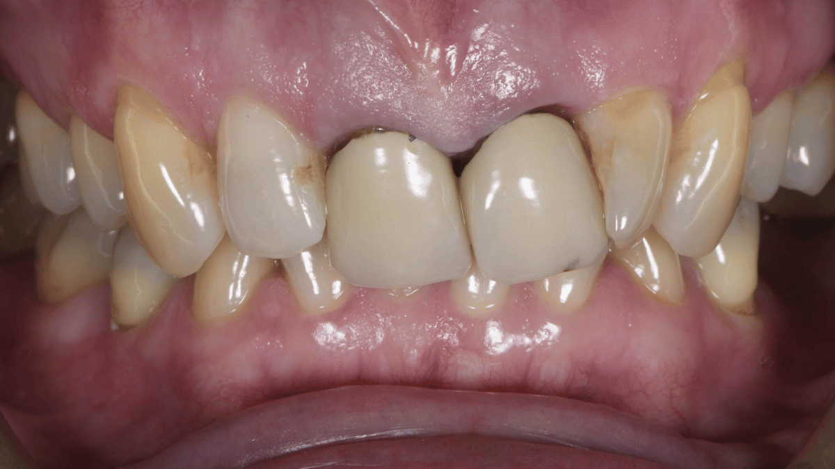 Full mouth rehab 1 before 9_16