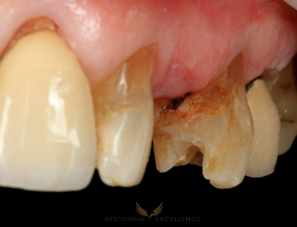 Replacing Composite FPD