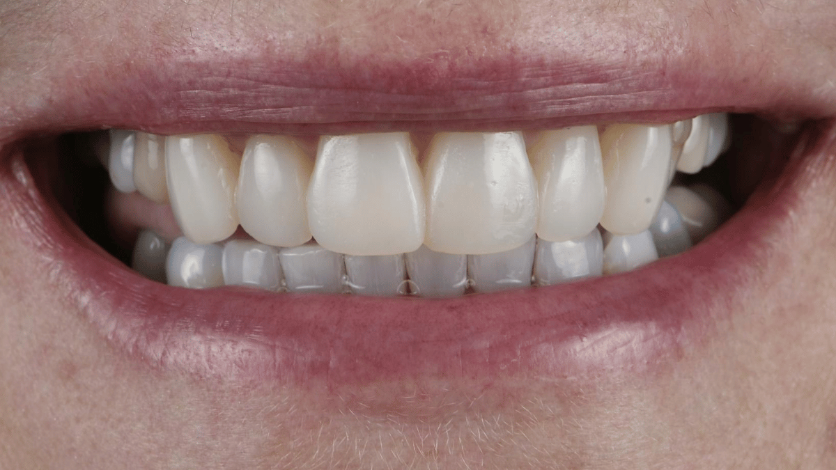 Layered Composite Veneers 1 After 9_16