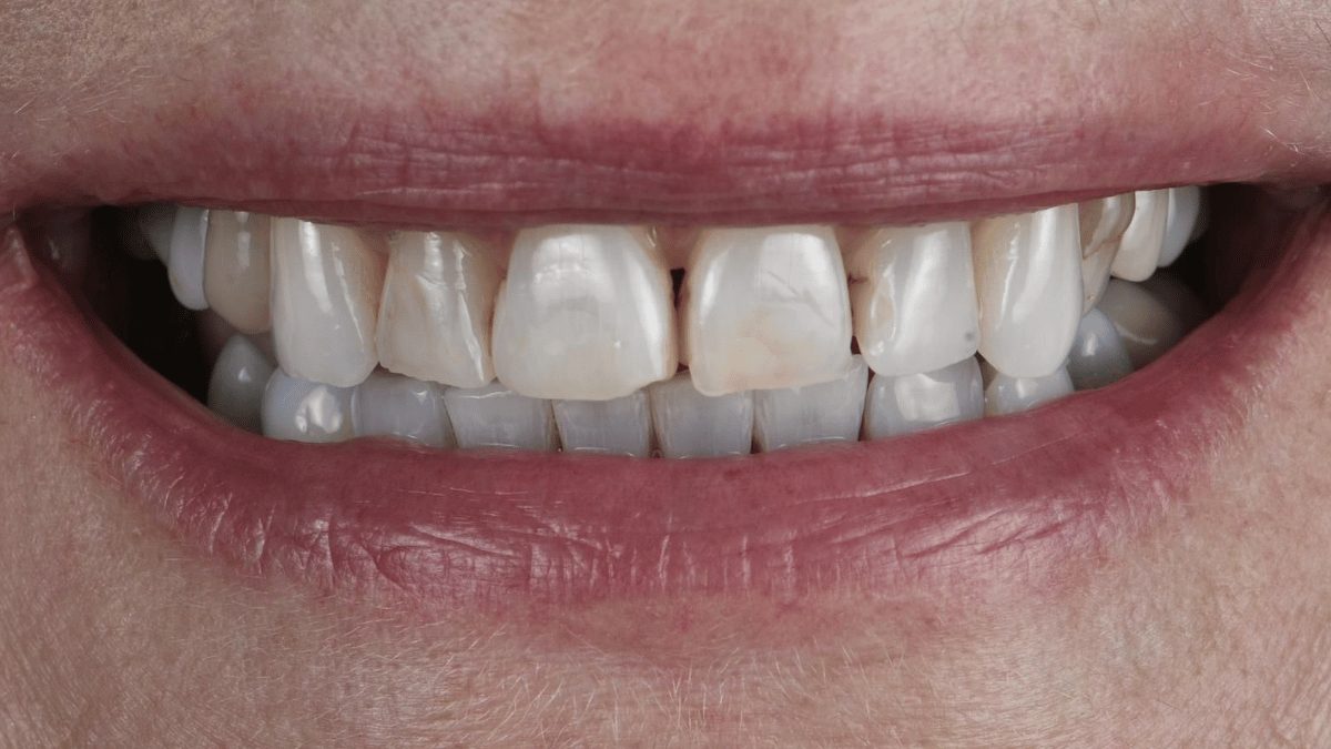 Layered Composite Veneers 1 Before 9_16