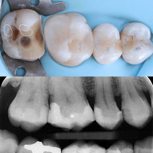 MKT-240604-Lincoln-Cusps - Post 3 Pam Emax Case slide 3 MKT-240604-Lincoln-Cusps - Post 3 Pam Emax Case slide 3
