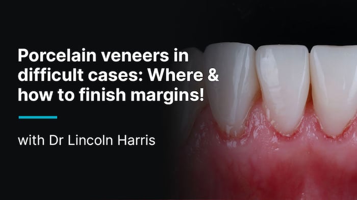 Video-Content-Thumbnail-MC041121-Harris-Porcelain-Veneers-800x450