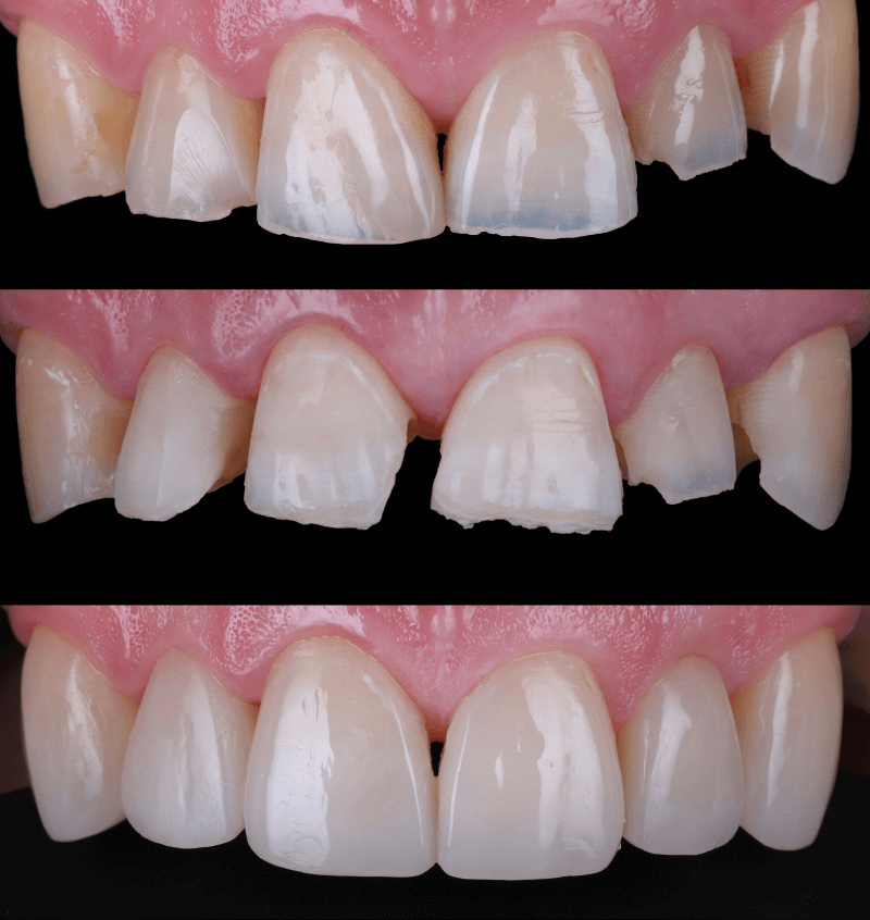 P5 - Preparing 10 Veneers and temporaries - Restorative Virtual Dental Residency