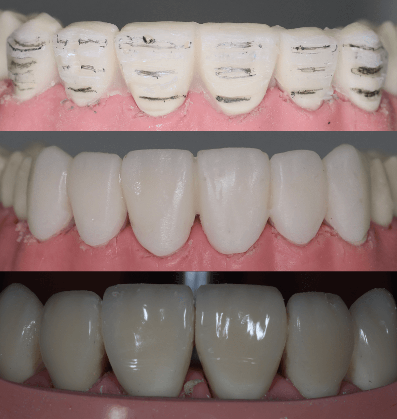 P6 - 6-layered veneers - Restorative Virtual Dental Residency