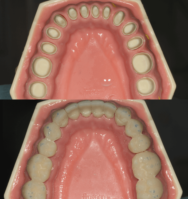 P7 8 - Full Mouth Rehab - Restorative Virtual Dental Residency