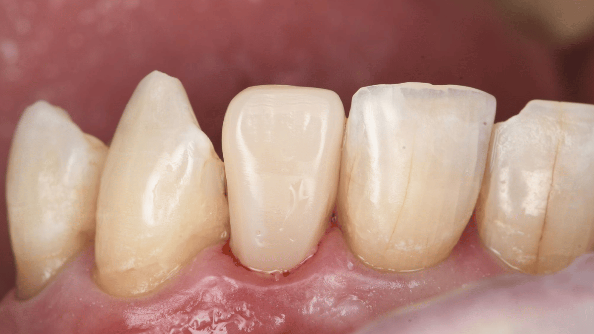 Posterior and Anterior Composites 1 after 9_16