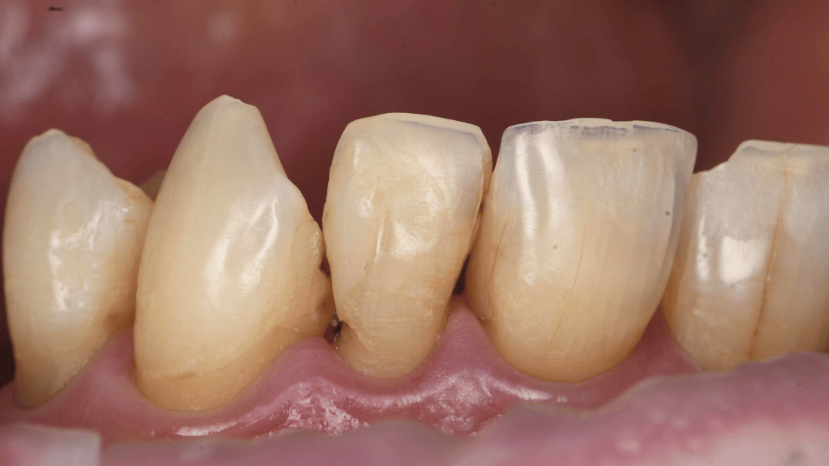 Posterior and Anterior Composites 1 before 9_16