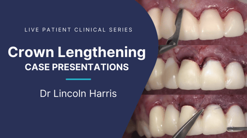 Crown and Bridge Prep Dental Training Videos