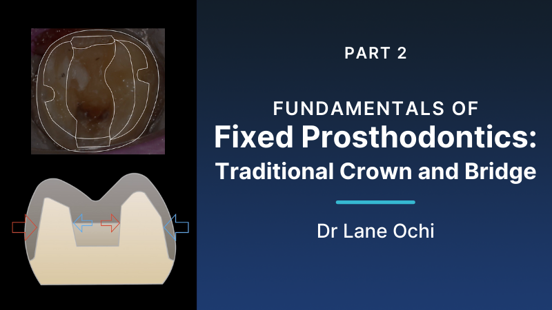 Video-Content-Ochi-Fundamentals-of-Fixed-Prosthodontics-traditional-crown-and-bridge-800
