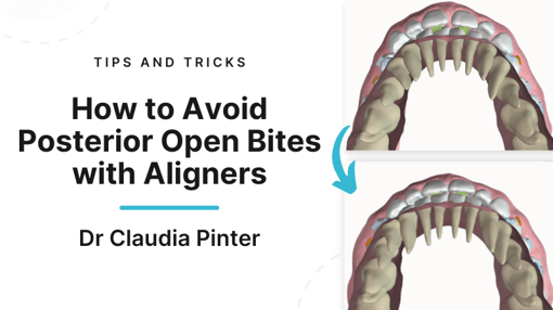 Aligners