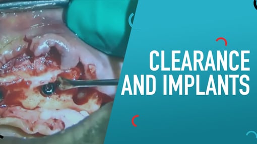 Implant Dental Training Videos