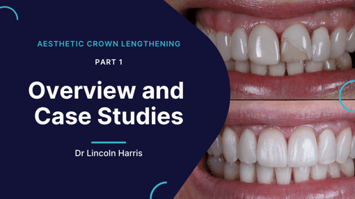 Crown and Bridge Prep Dental Training Videos