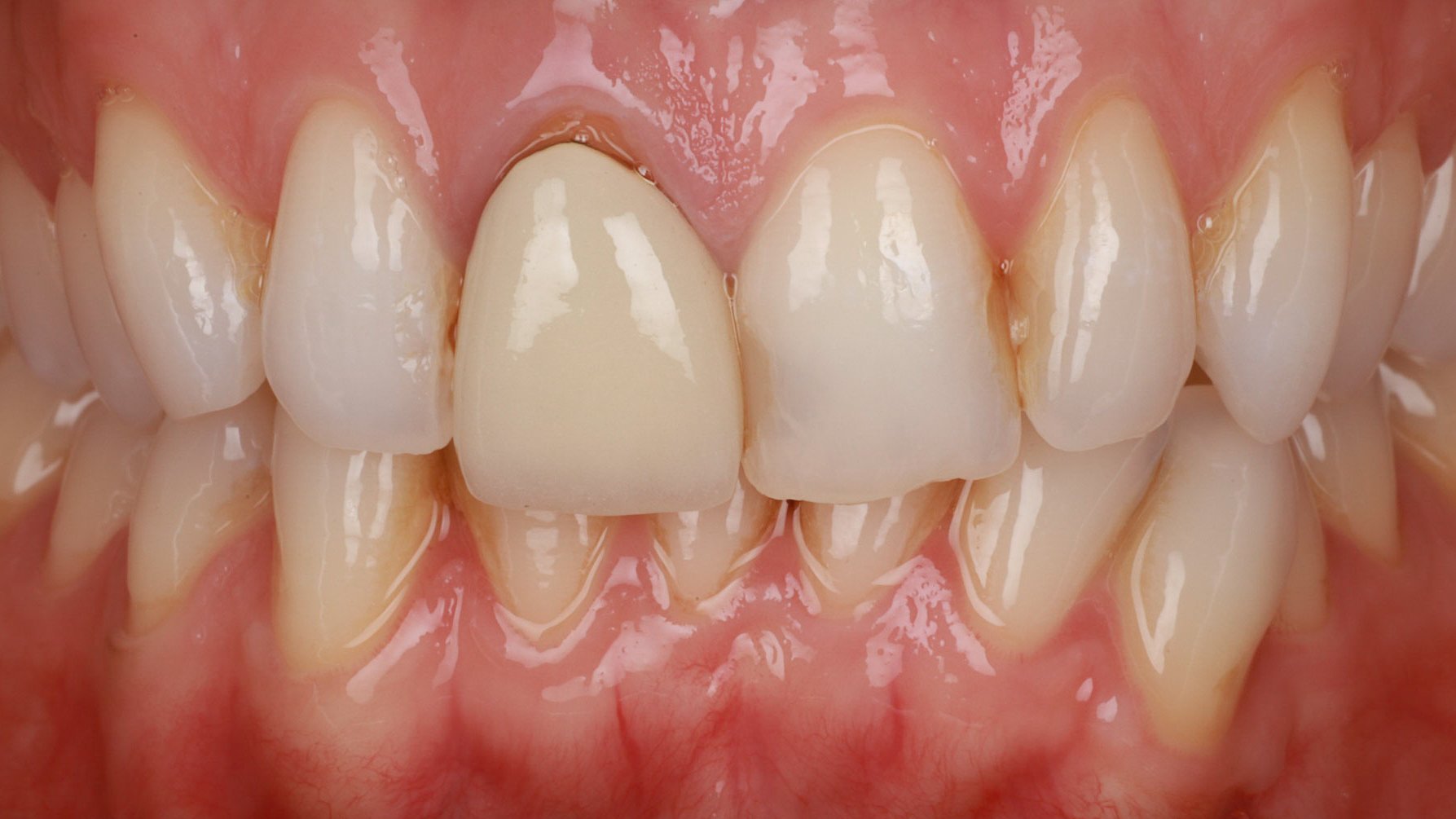 DR Josh Sharpling Masterclass 'one patient, one tooth, one year' image of anterior teeth DR Josh Sharpling Masterclass 'one patient, one tooth, one year' image of anterior teeth