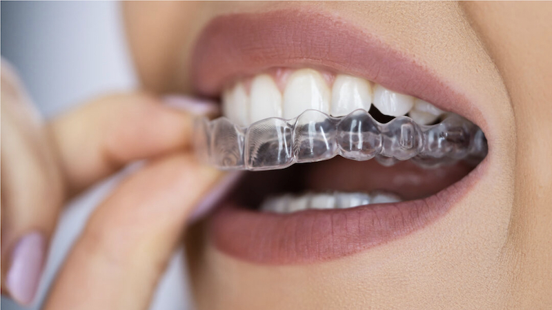 240311 Praveen Troubleshooting Clear Aligners 240311 Praveen Troubleshooting Clear Aligners