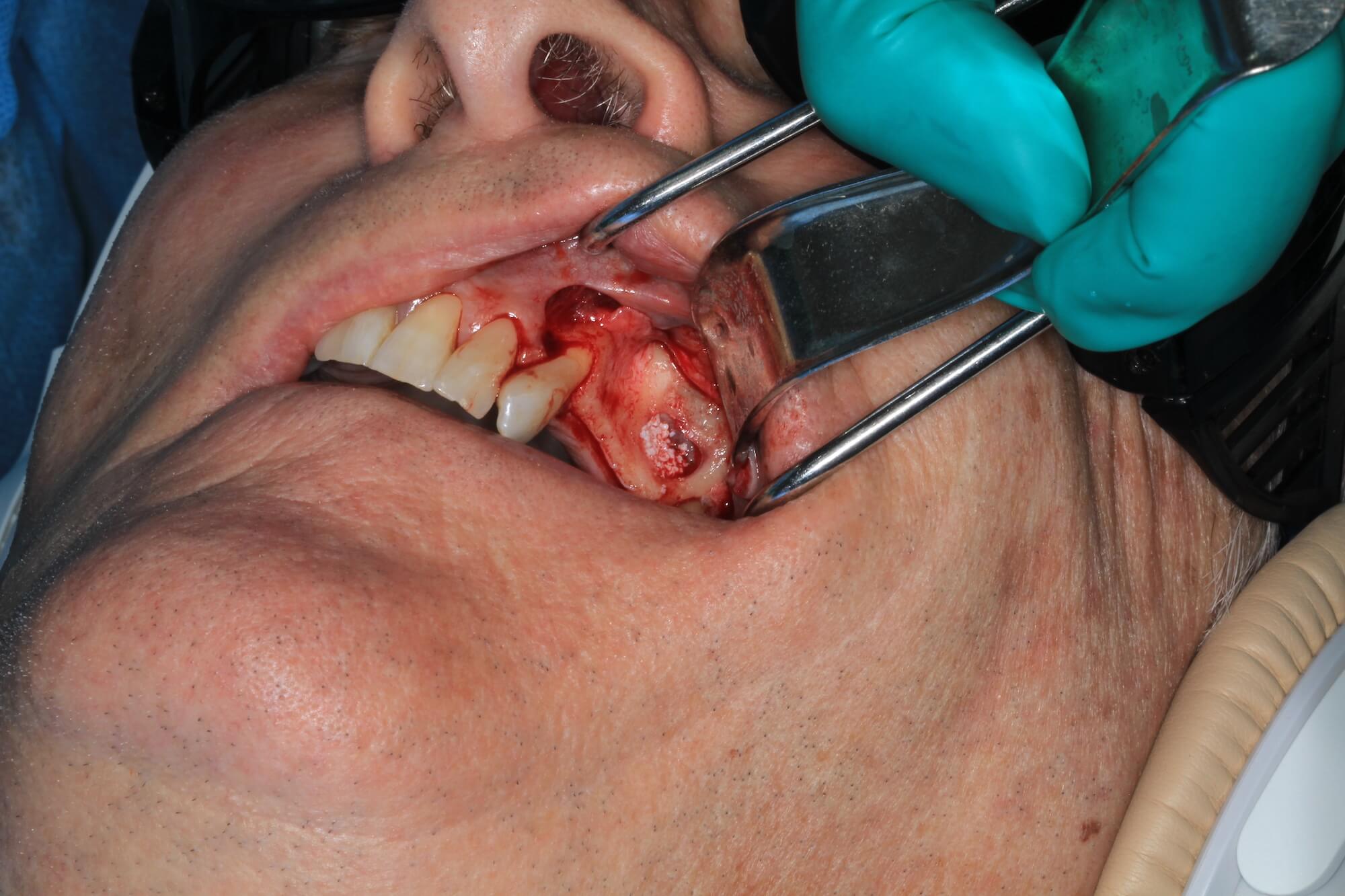 Soft tissue grafts