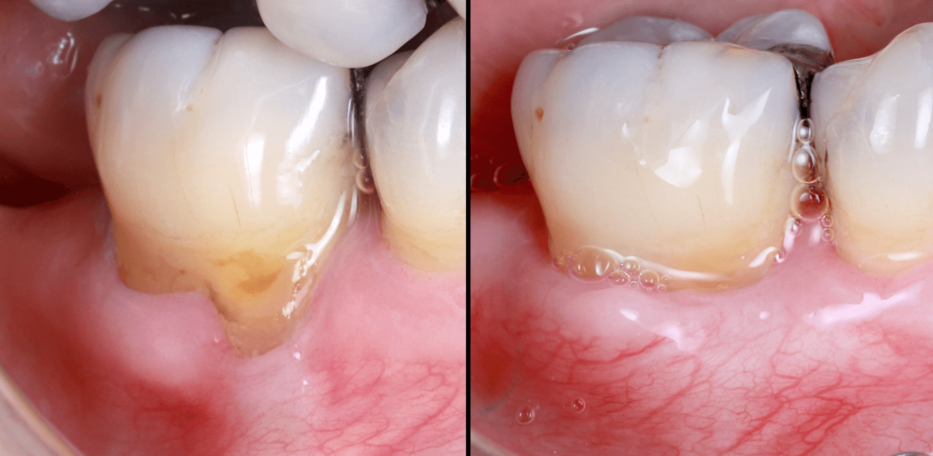 Sinus lifts