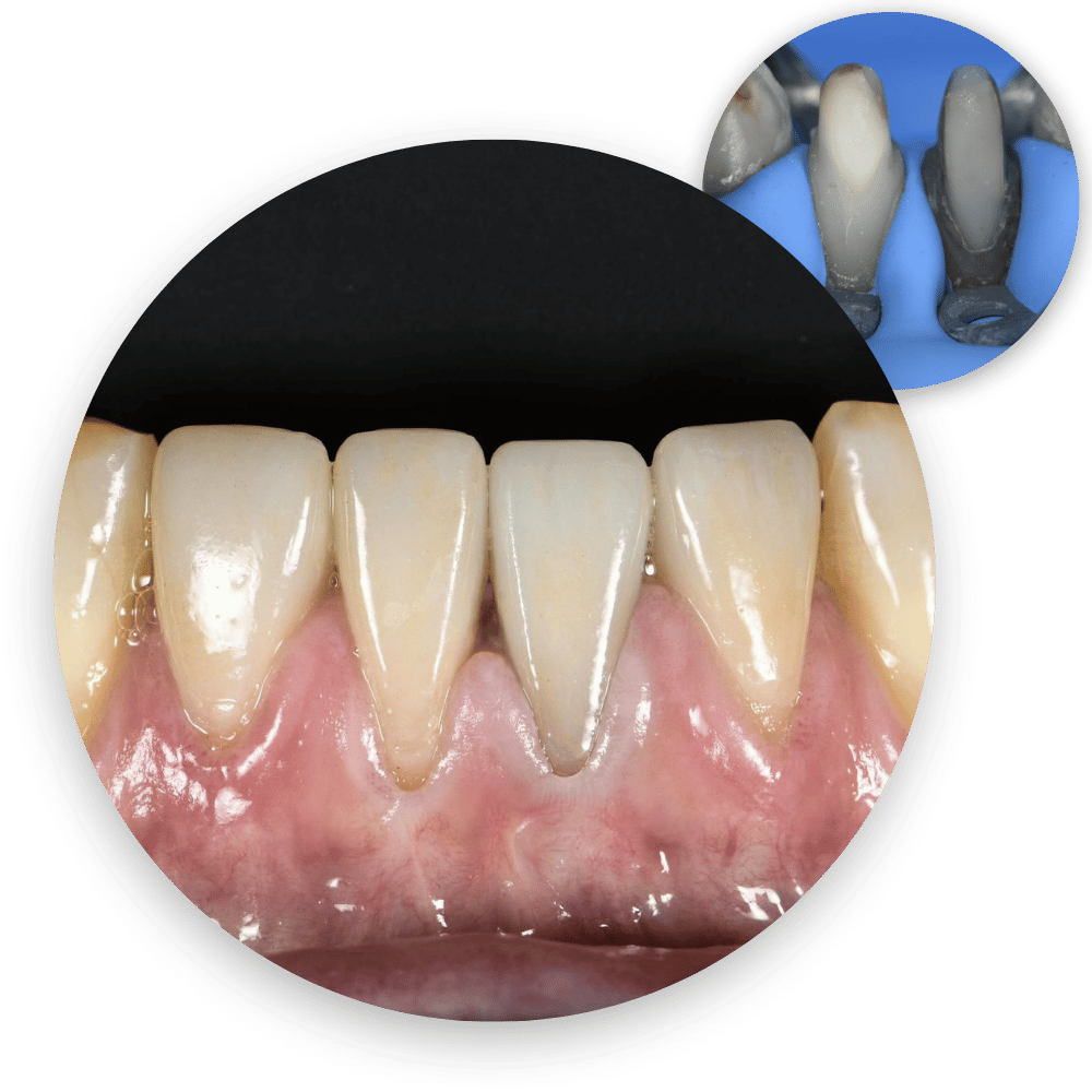 Anterior Crowns and Provisionals