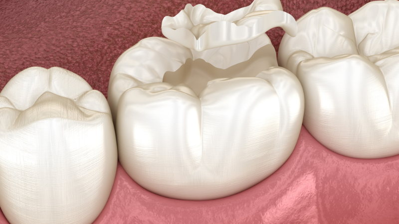 Cracked Teeth and Occlusion: Why Teeth Break and How Better Planning Can Help Prevent It