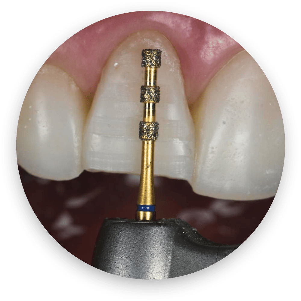 Ceramic Veneers