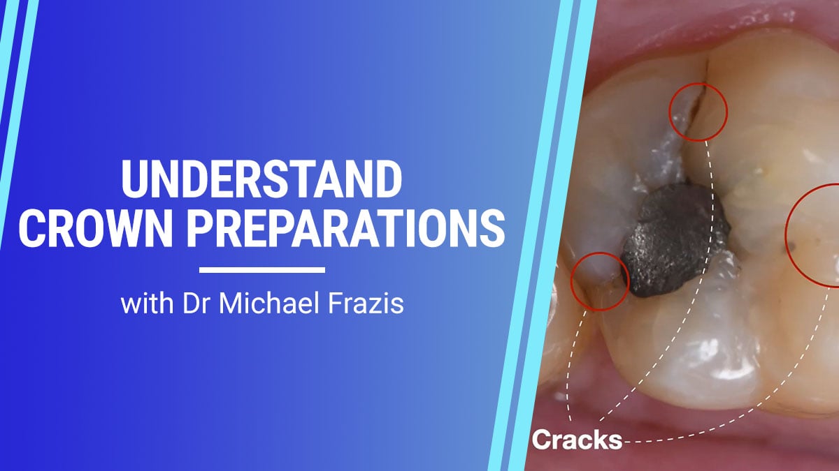 Understanding Crown Preparations