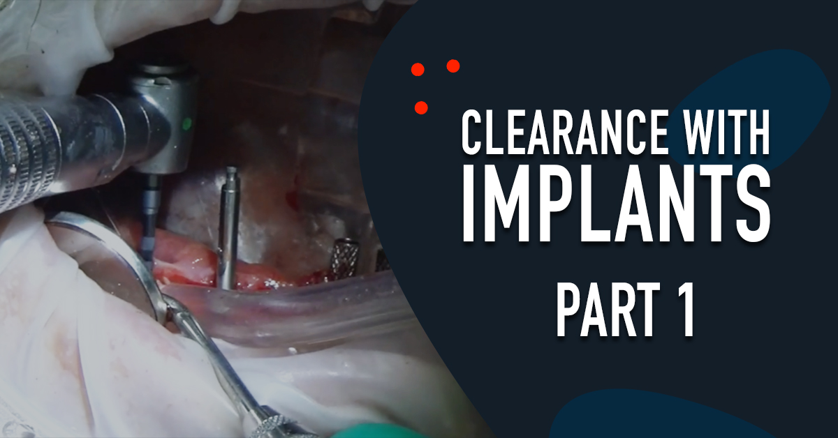 Clearance with Implants - Part 1