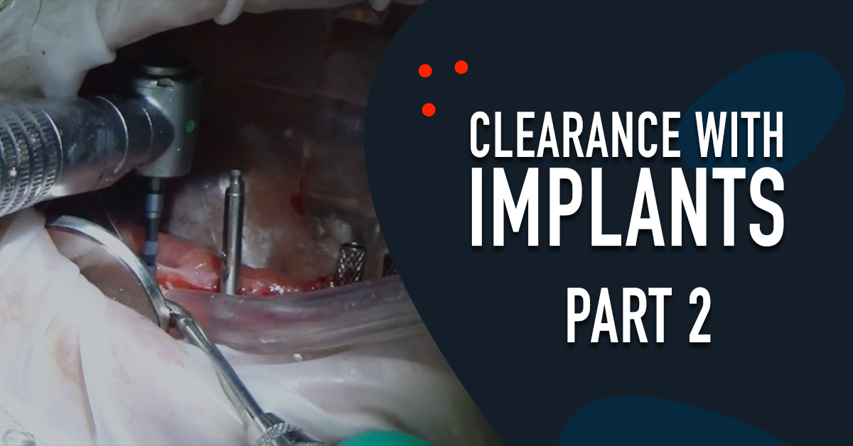 Clearance with Implants - Part 2