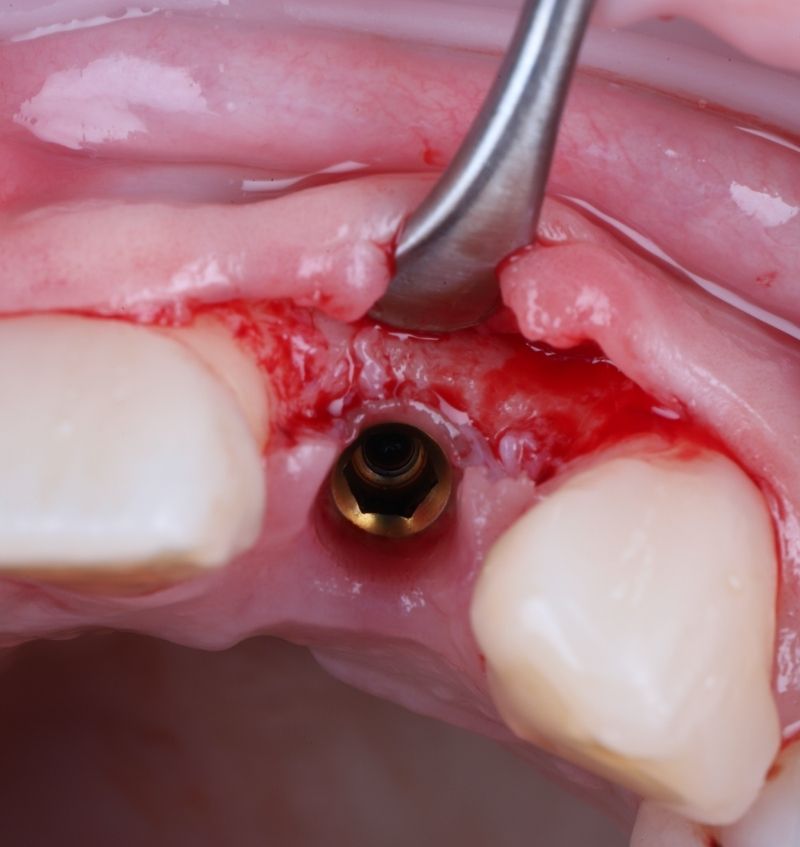 FMI 800x847 - Module 1 - Atraumatic Extraction, Socket and Bone Grafting