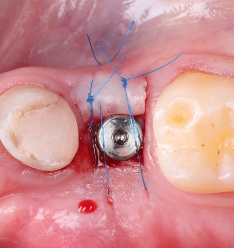 FMI 800x847 - Module 2 - Single Implant Placement in an Edentulous Site