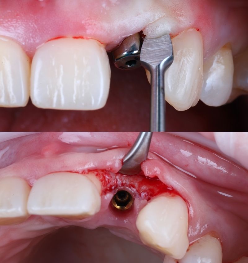 FMI 800x847 - Module 3 - Soft Tissue Augmentation