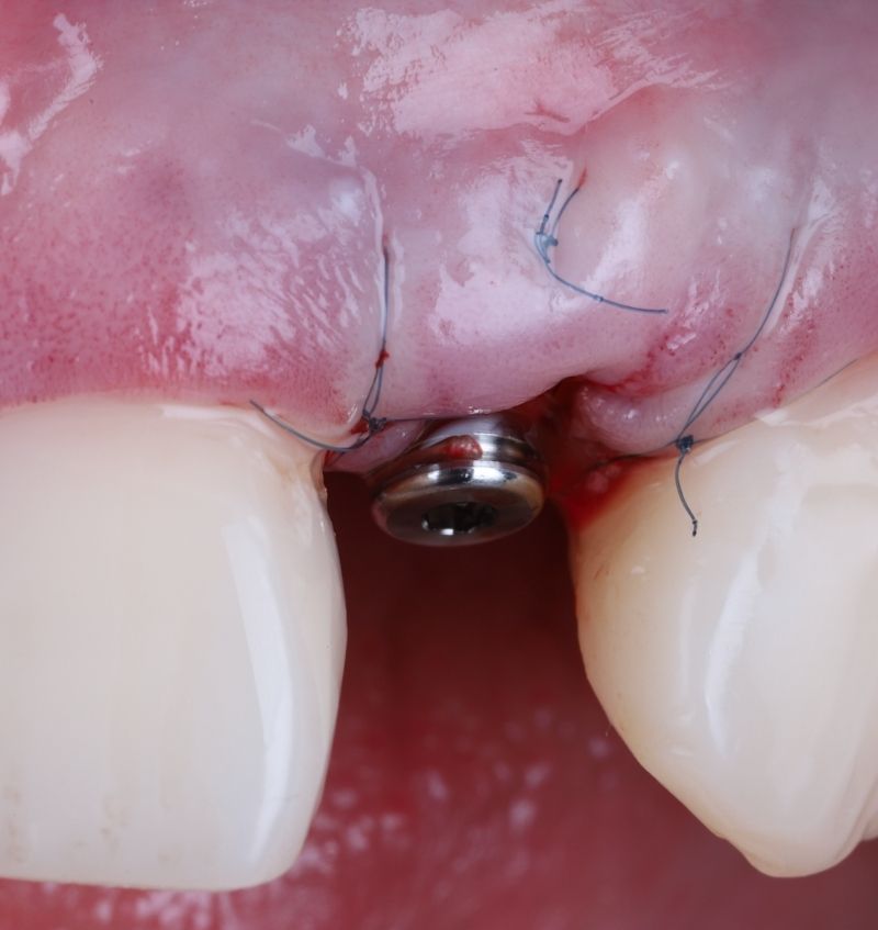 FMI 800x847 - Module 5 - Restoration and Guided Implantology for Single Site