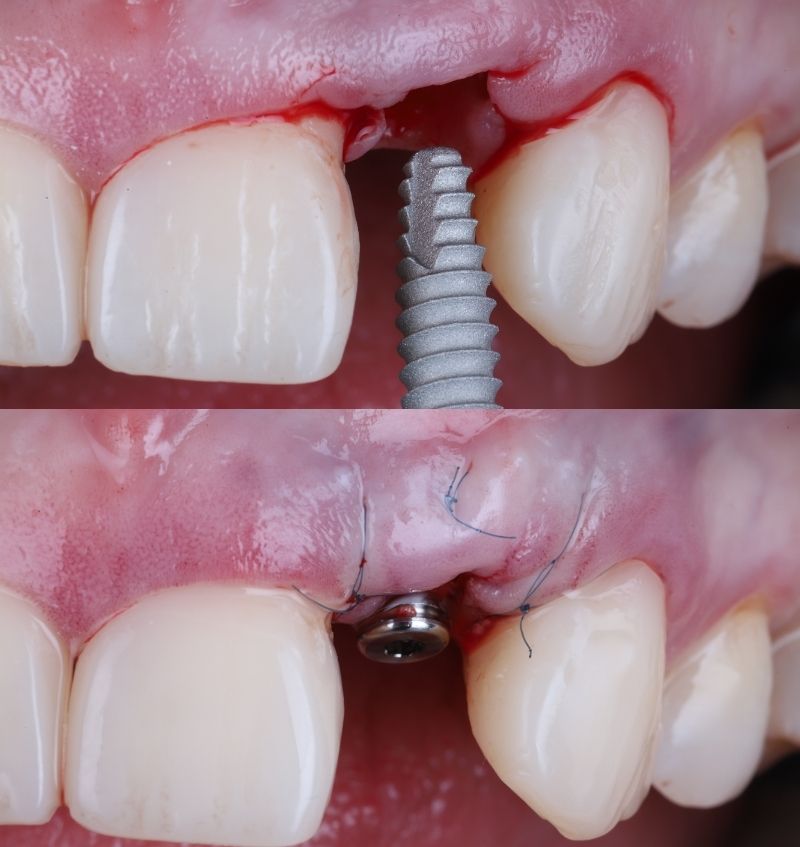 FMI 800x847 - Module 6 - Immediate Placement of Anterior and Posterior Implants