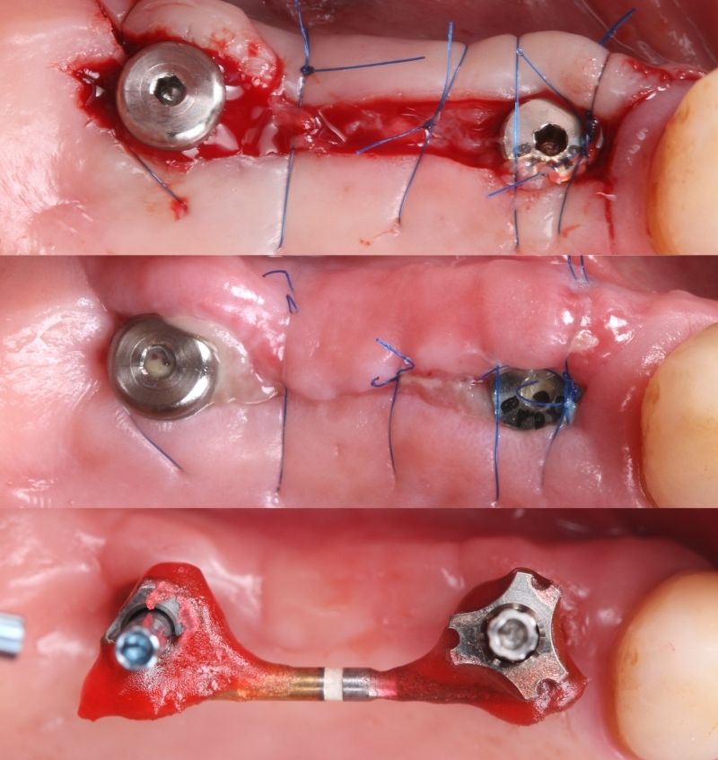 FMI 800x847 - Module 7 - Placing Multiple Implants Simultaneously