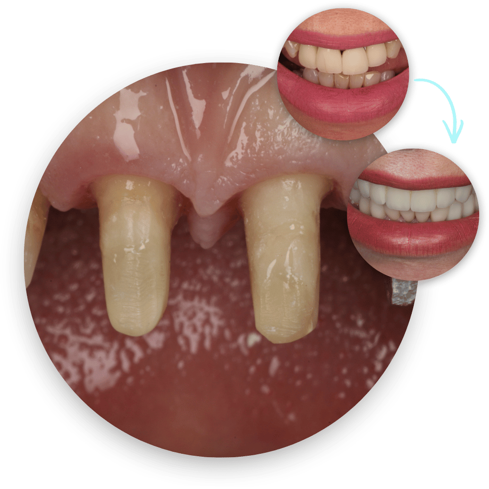 Full Mouth Rehabilitation