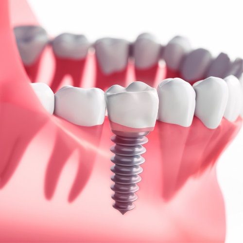 Implantology Implantology