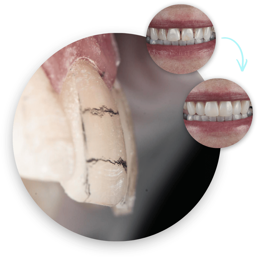 Layered Composite Veneers