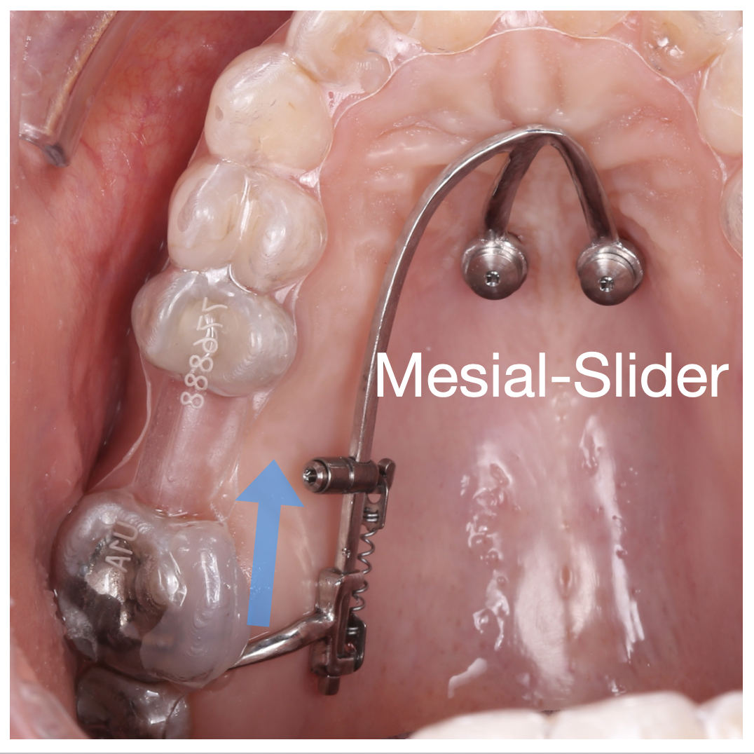Molar Mesialization using the Mesialslider + Aligners masterclass image 2 Molar Mesialization using the Mesialslider + Aligners masterclass image 2