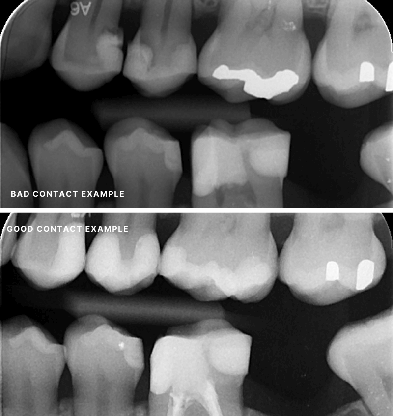 P2 - Quadrant Composites with Good Contacts - Restorative Virtual Dental Residency