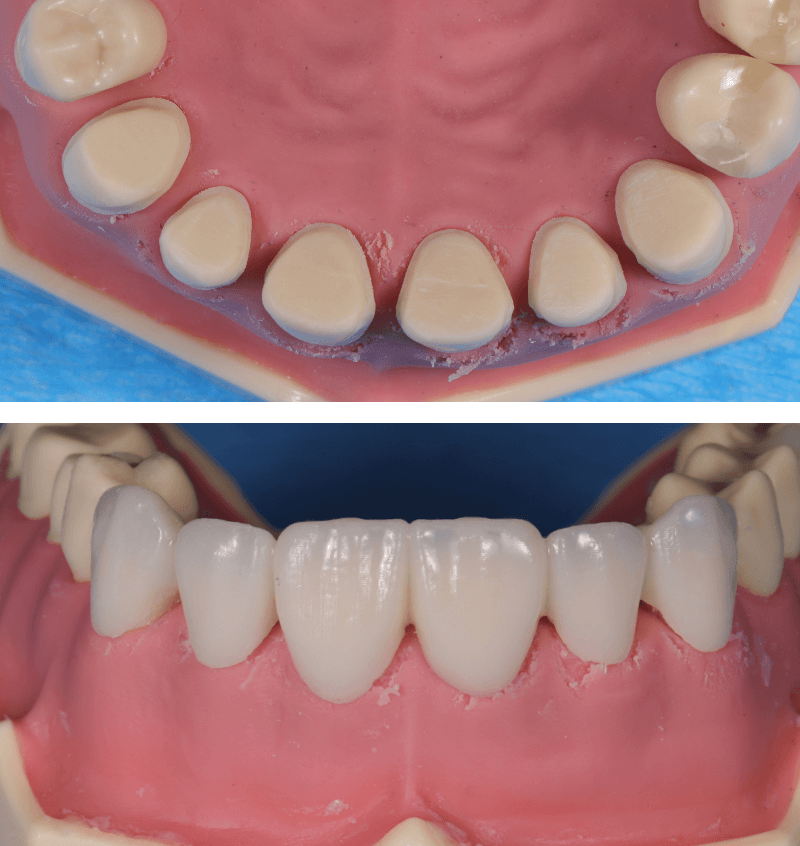 P3 - 6 Anterior Crowns and Temporaries in 4 hours - Restorative Virtual Dental Residency