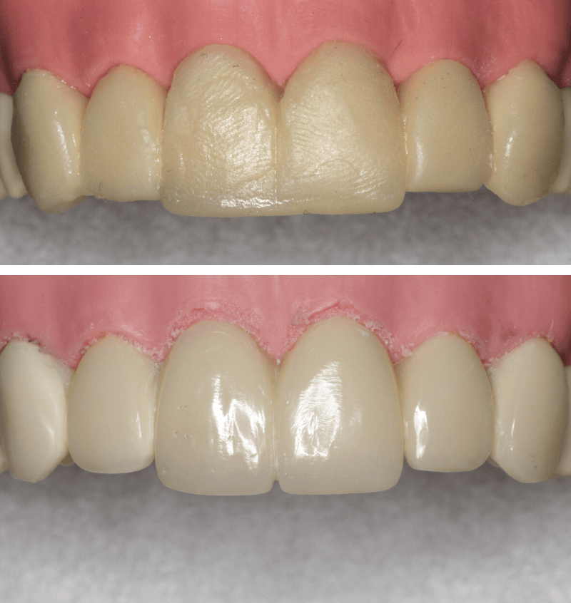 P4 - 6 Quality Anterior Composites - Restorative Virtual Dental Residency