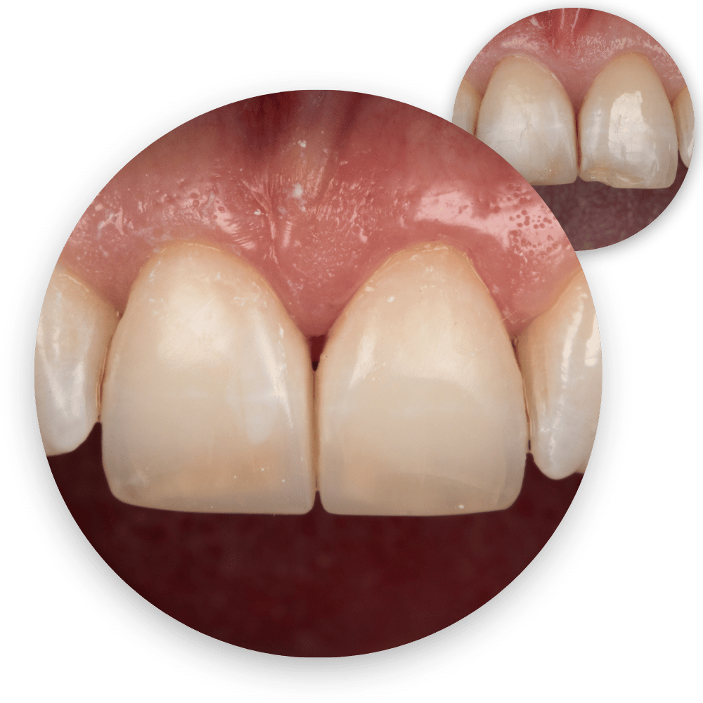 Posterior and Anterior Composites Posterior and Anterior Composites