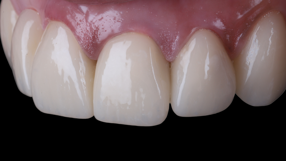 RMS - Anterior Crowns and Provisionals
