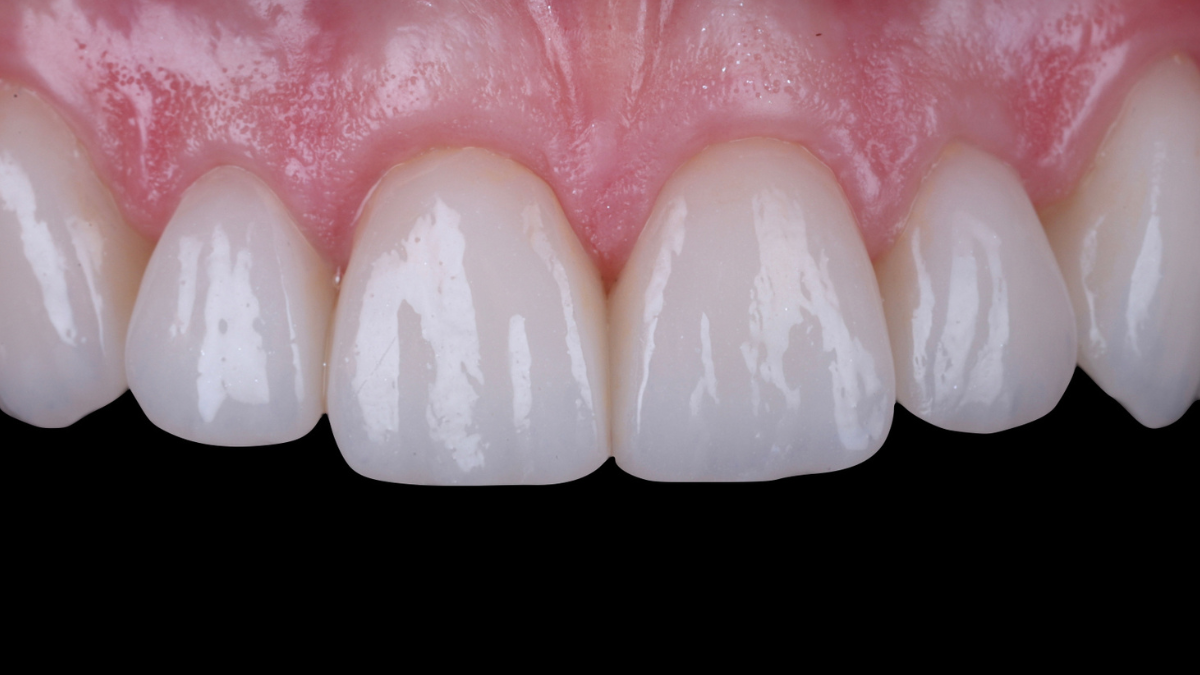 RMS - Ceramic Veneers