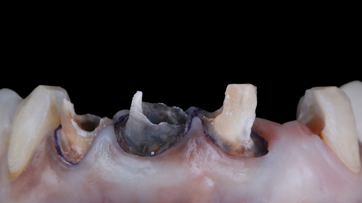 RMS - Full Mouth Rehabilitation
