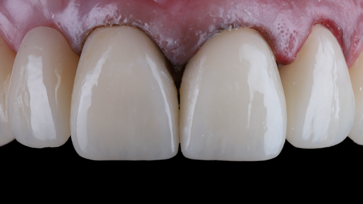 RMS - Layered Composite Veneers