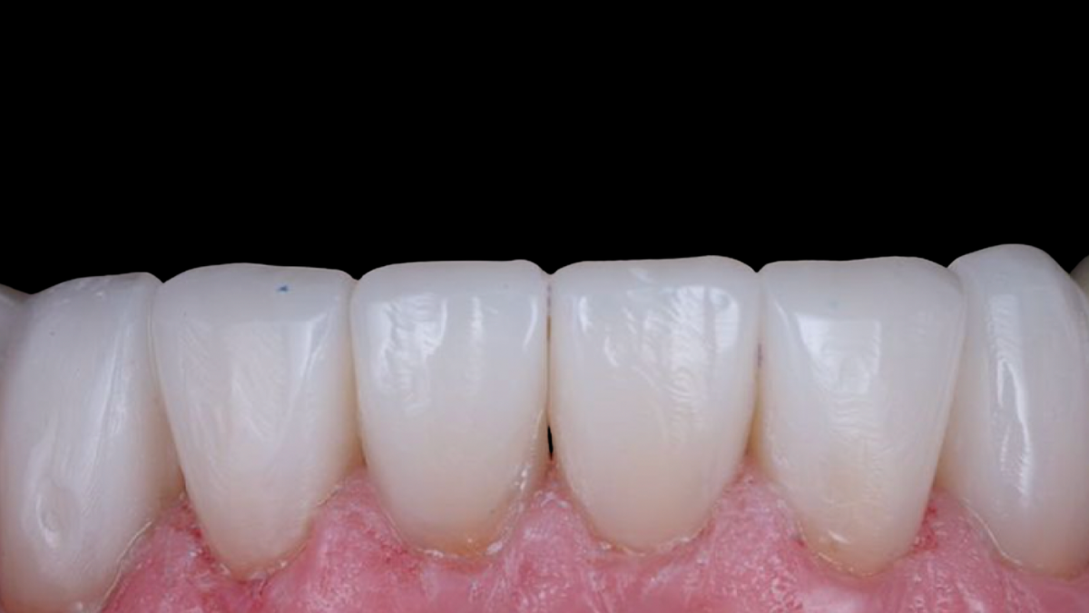 RMS - Posterior and Anterior Composites