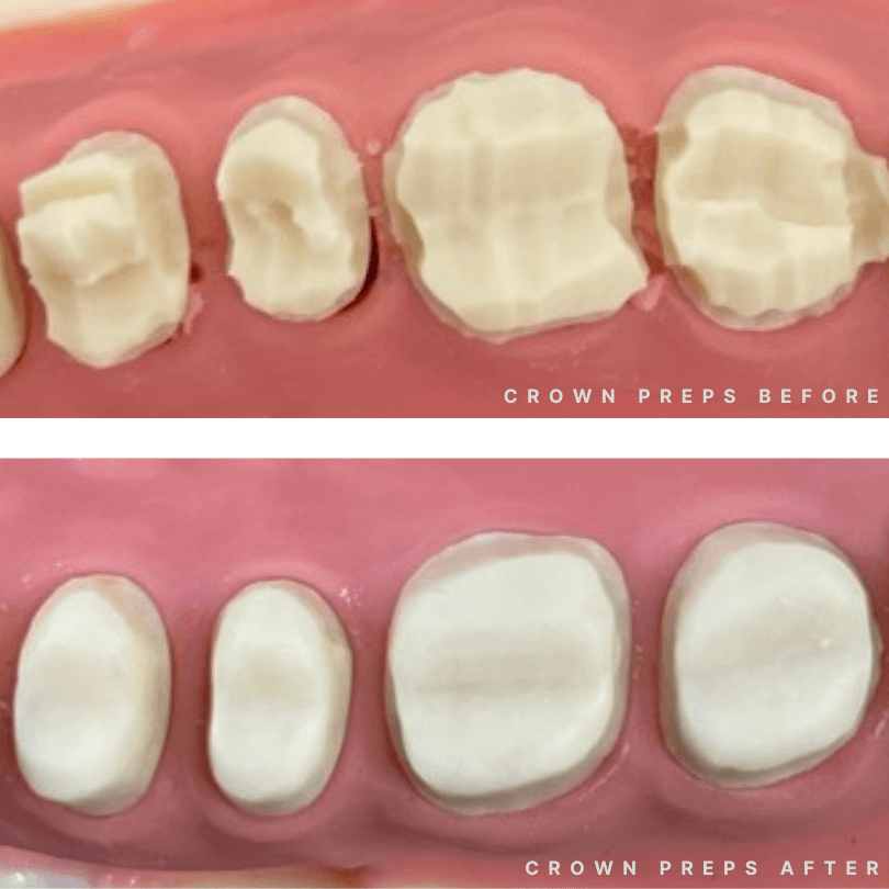 RipeGlobal Restorative Crown Preps Before After